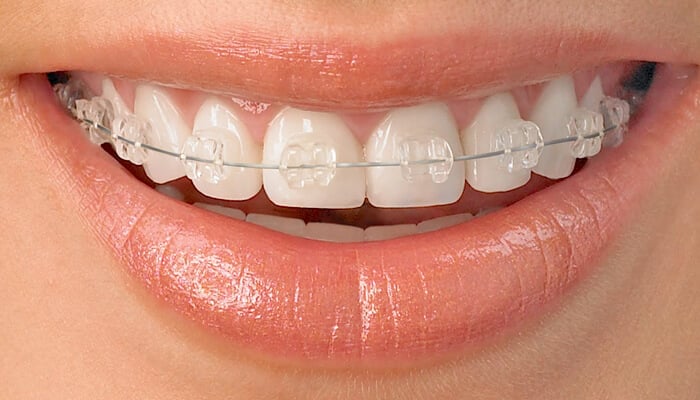 Closing the Gap: How 6 Month Braces Can Transform Your Smile