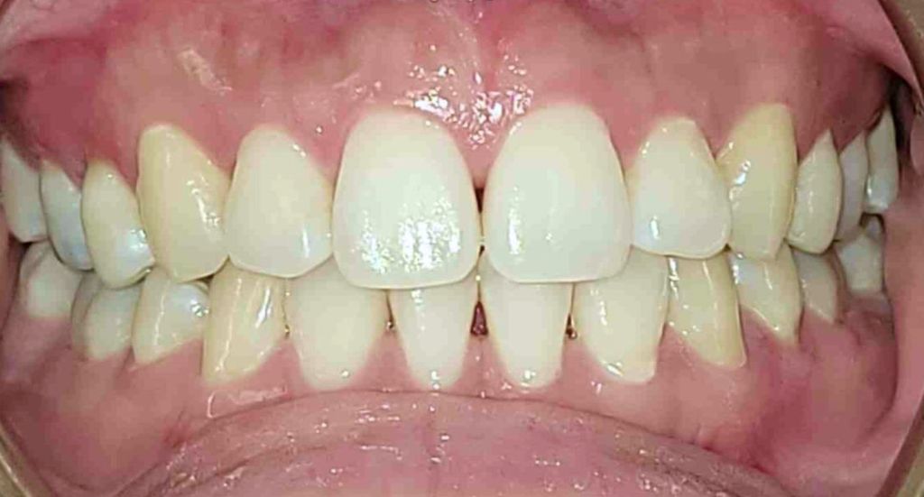 Perfecting Smiles: Black Triangles in Orthodontic Treatment