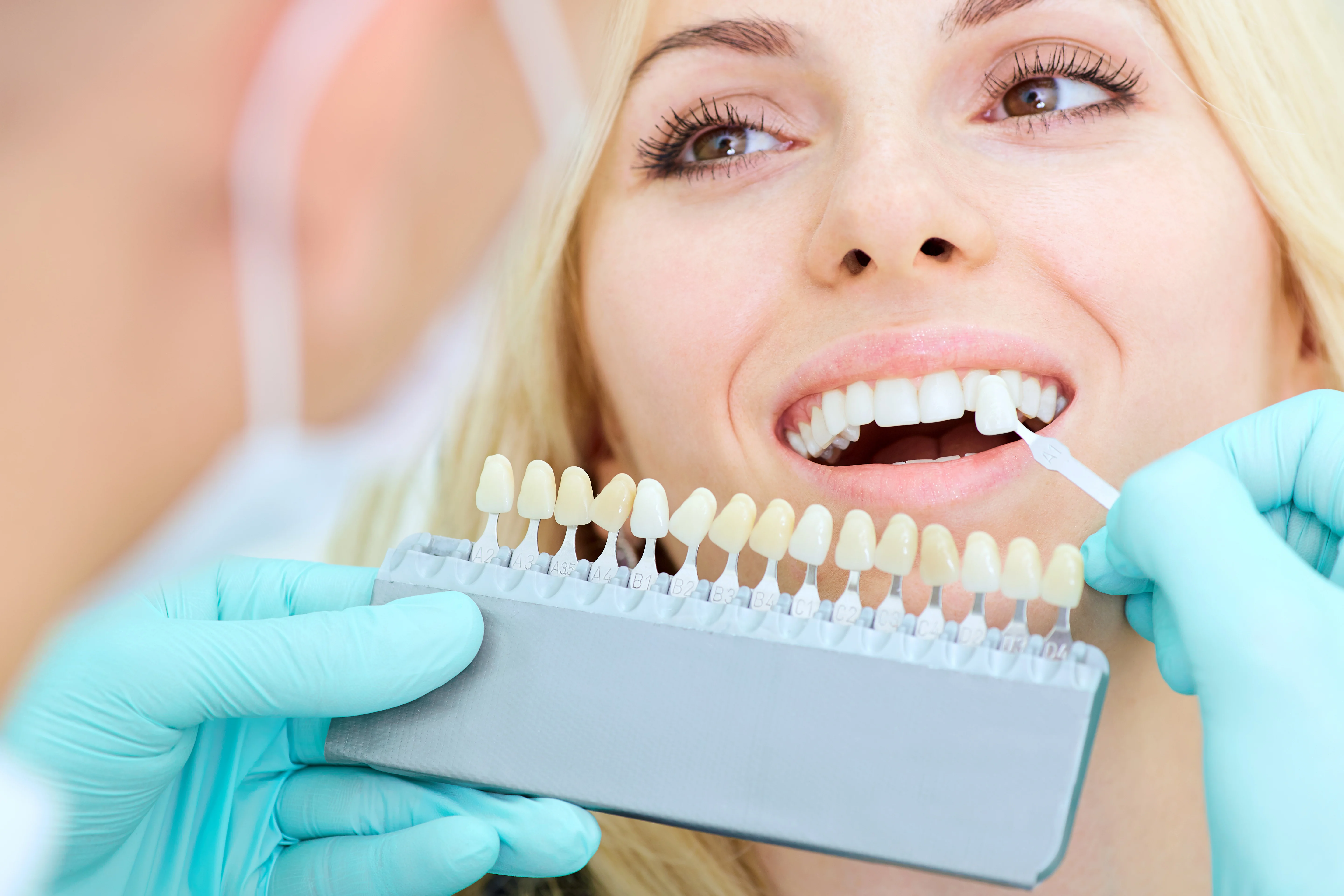 Professional Teeth Whitening: Is It Worth the Cost?