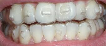 Invisalign attachments 