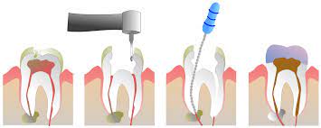 RCT treatments