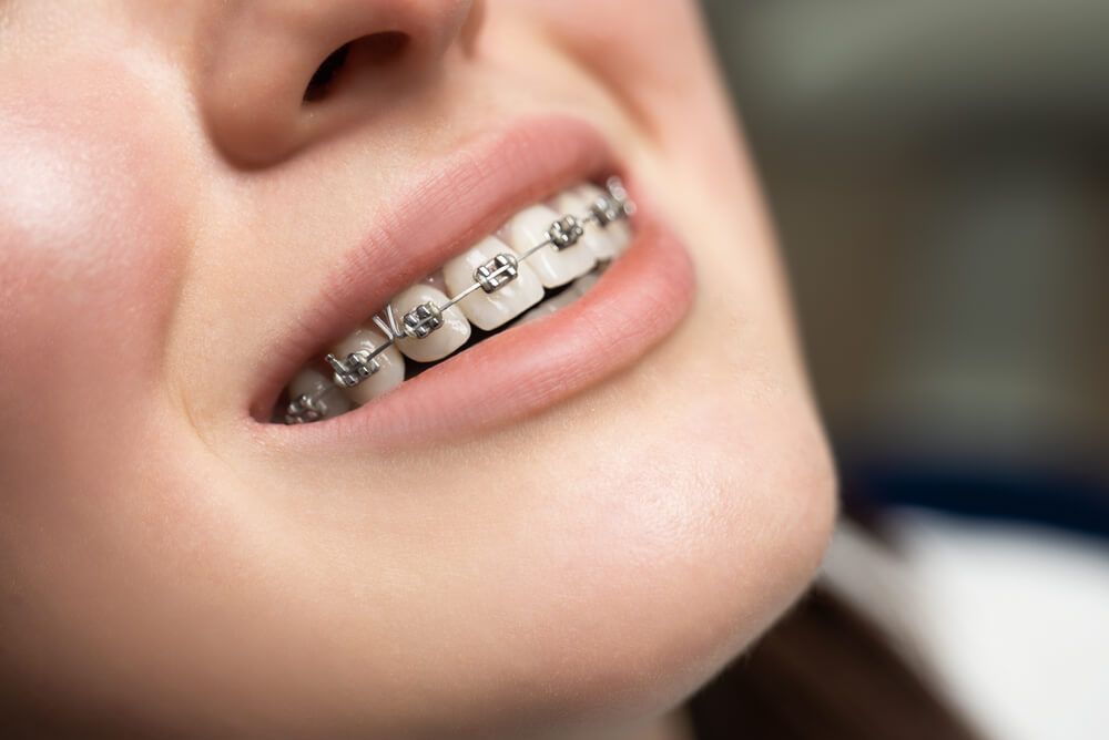 Understanding the Difference: Dentist vs. Orthodontist