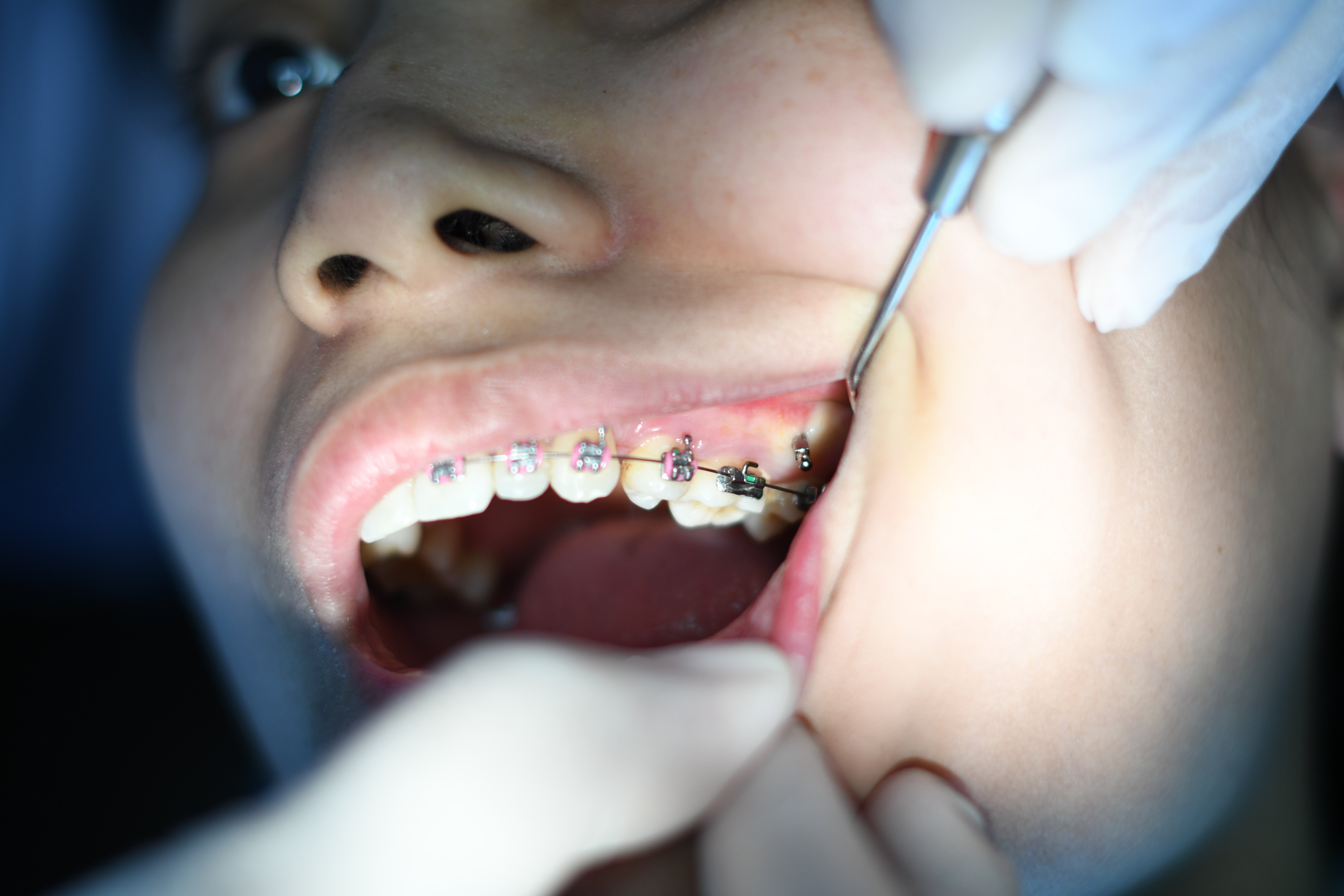 Understanding the Orthodontic Treatment Process