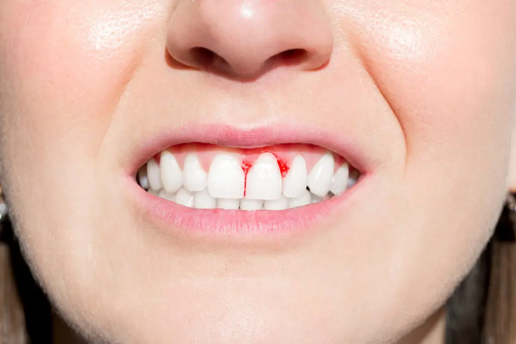 Causes and Prevention of Gum Disease