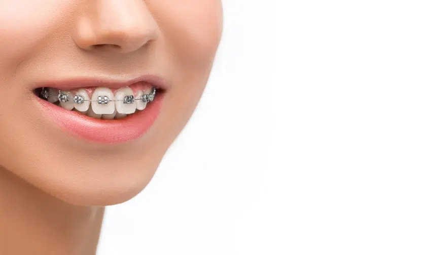 Braces on Top Teeth: What You Need to Know