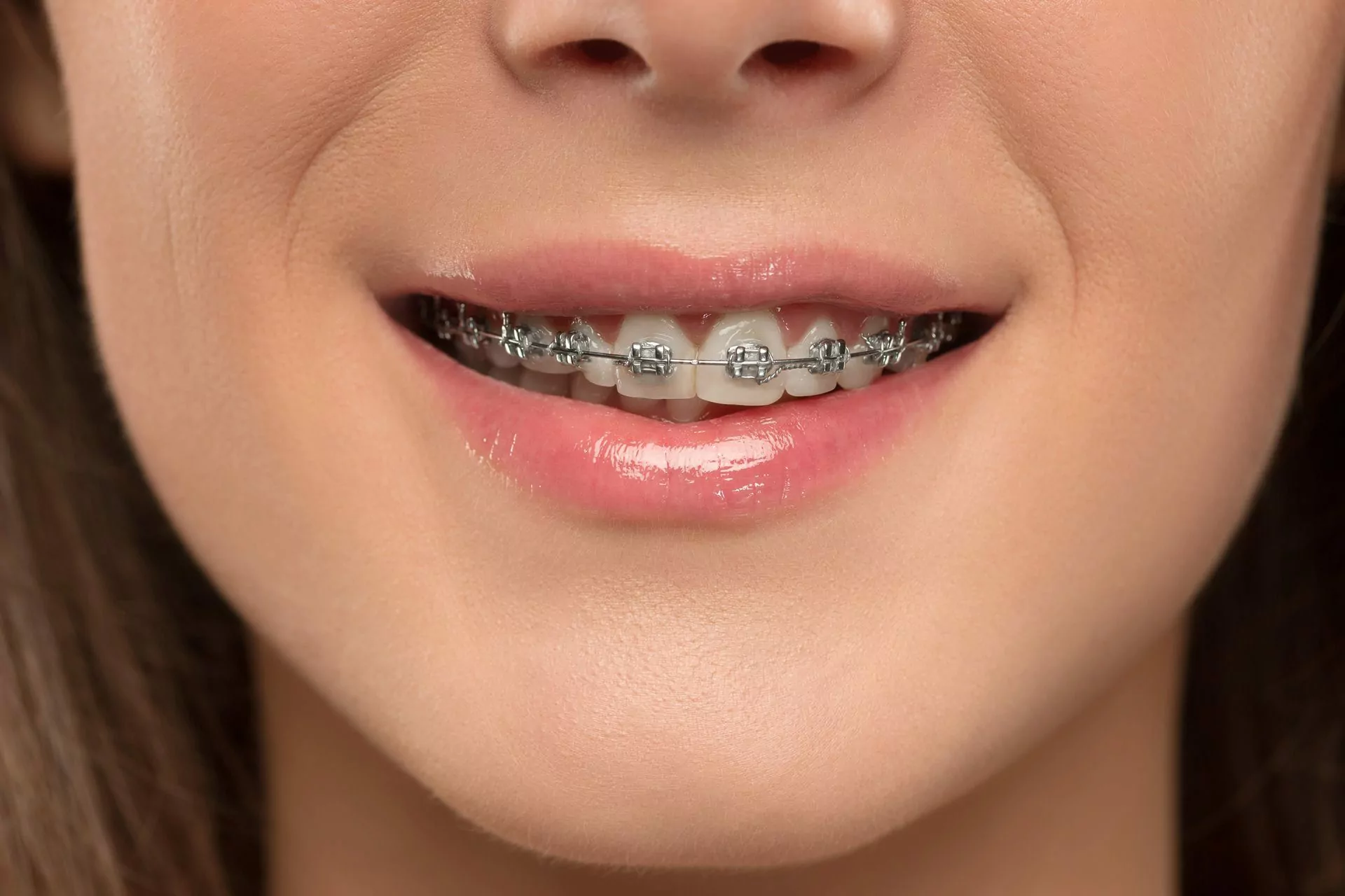 Pros and Cons of Braces and Invisalign: Making the Right Choice