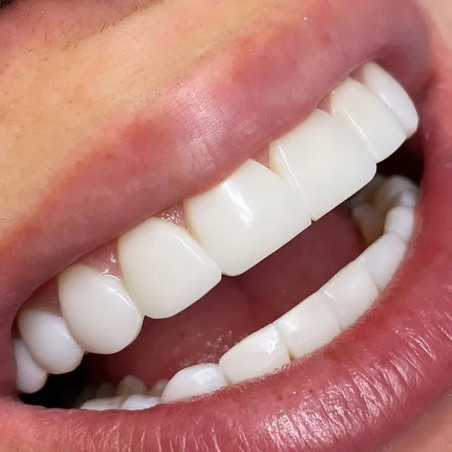 Composite Bonding vs Veneers: Which is Right for You?