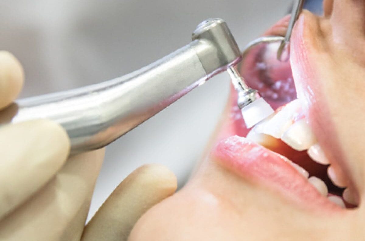 The Benefits of Professional Dental Cleaning