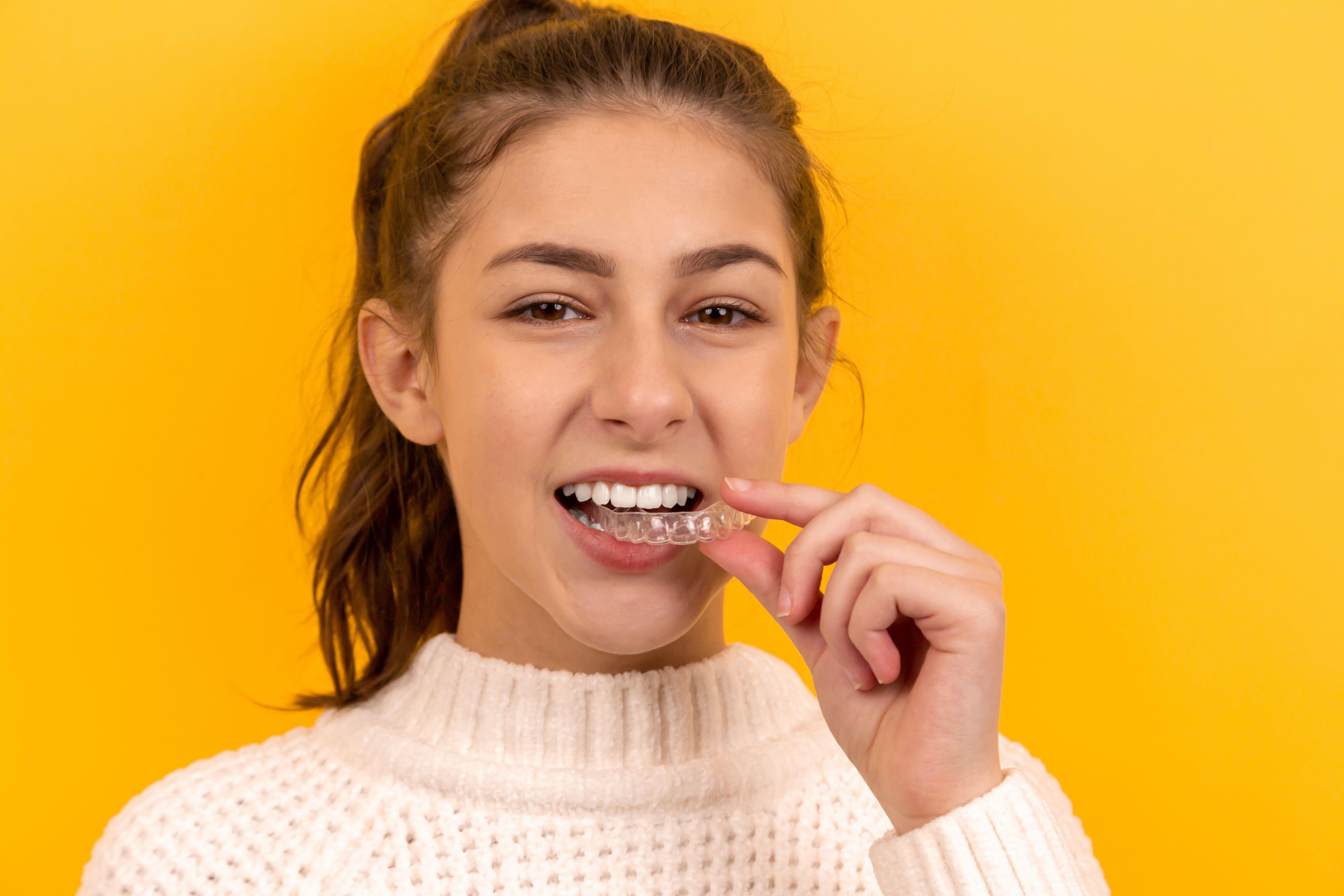 Reveal aligners