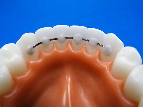 Everything You Need to Know About Bonded Retainers