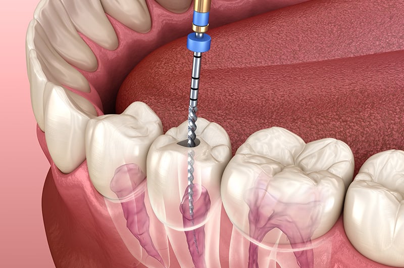 Endodontist vs Dentist: What's the Difference?