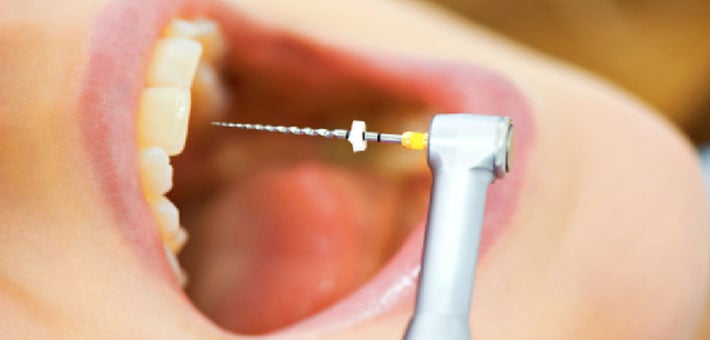 Root Canal Recovery: What to Expect After the Procedure