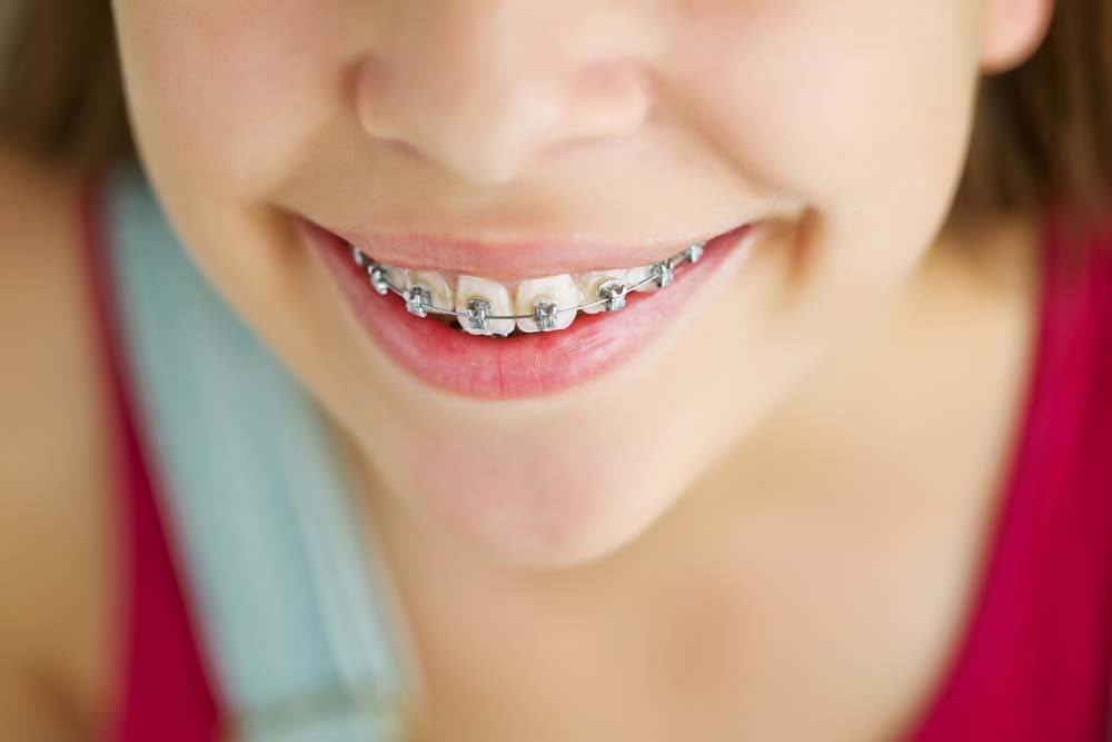 Exploring the Different Types of Orthodontic Treatment