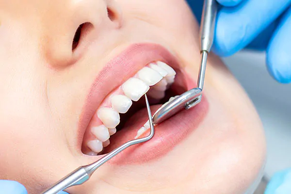 How Long Do White Fillings Last? A Comprehensive Guide