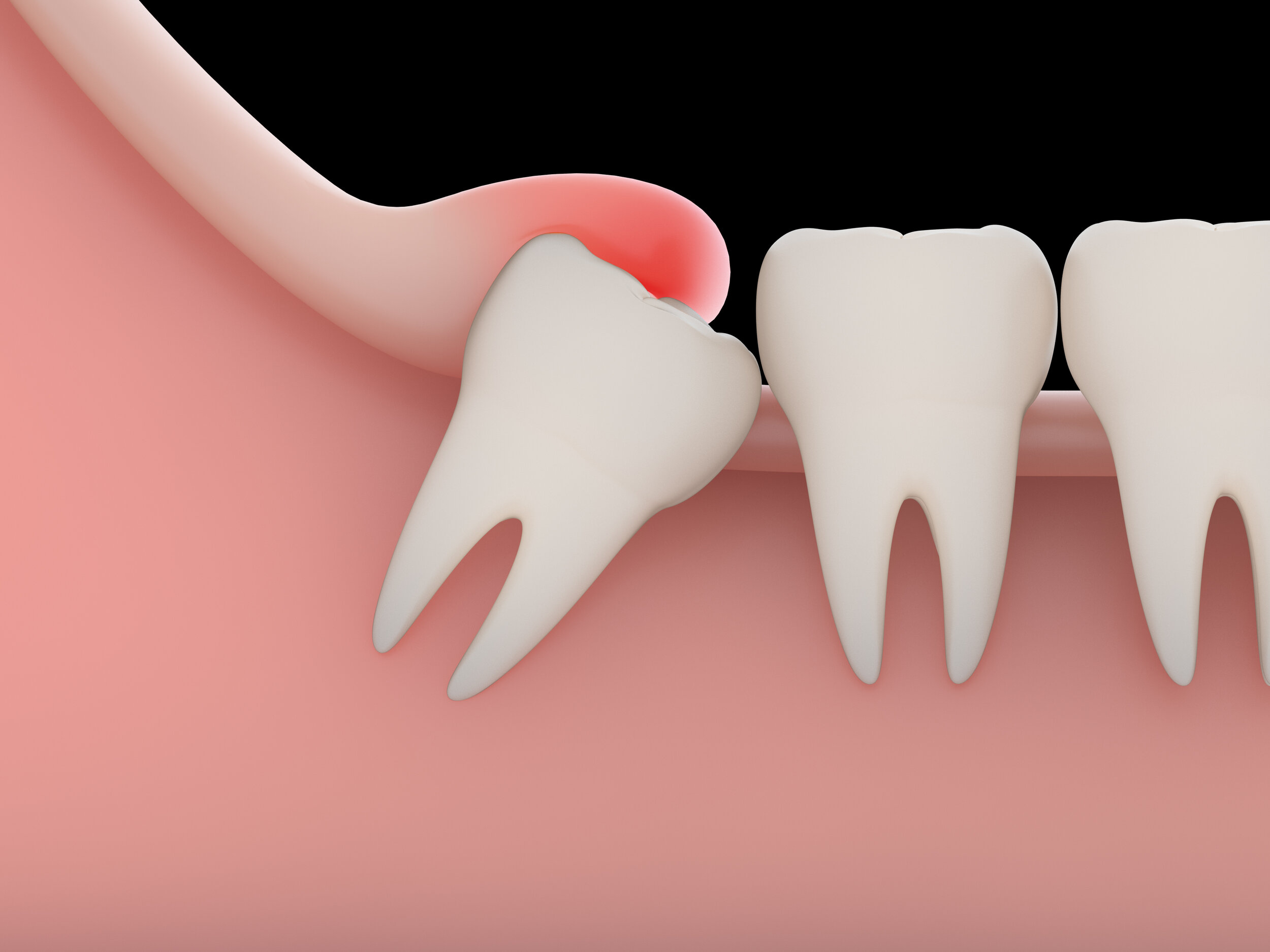 wisdom tooth